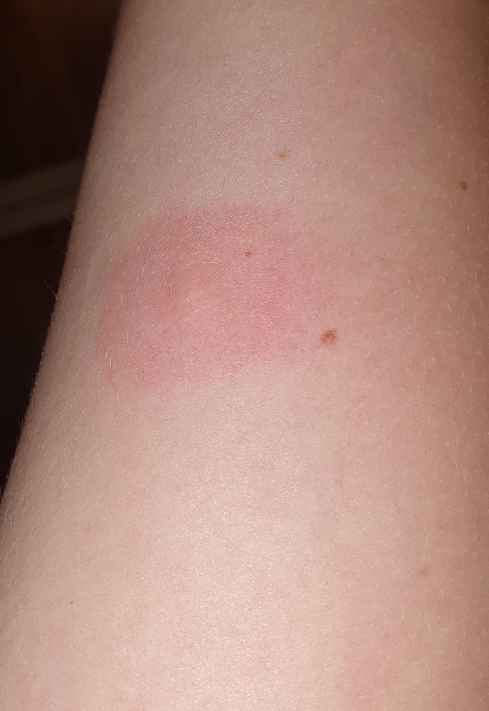 Roter Kreis Um Muckenstich Juckreiz Muckenstiche Roter Kreis Um Muckenstich Juckreiz Muckenstiche