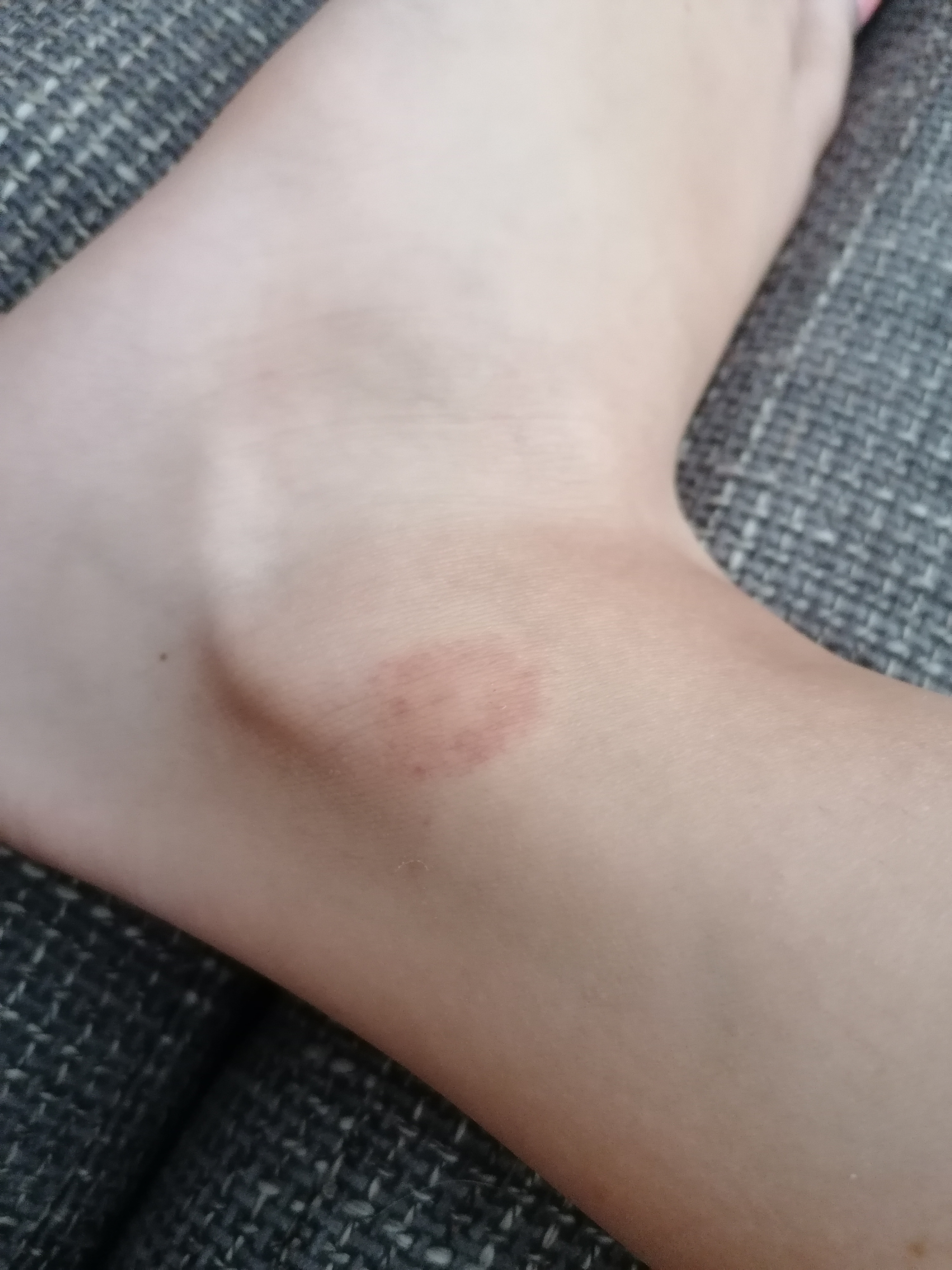 Roter Kreis Um Stich Kriebelmucke Gesundheit Und Medizin Gesundheit Medizin Roter Kreis Um Stich Kriebelmucke Gesundheit Und Medizin Gesundheit Medizin