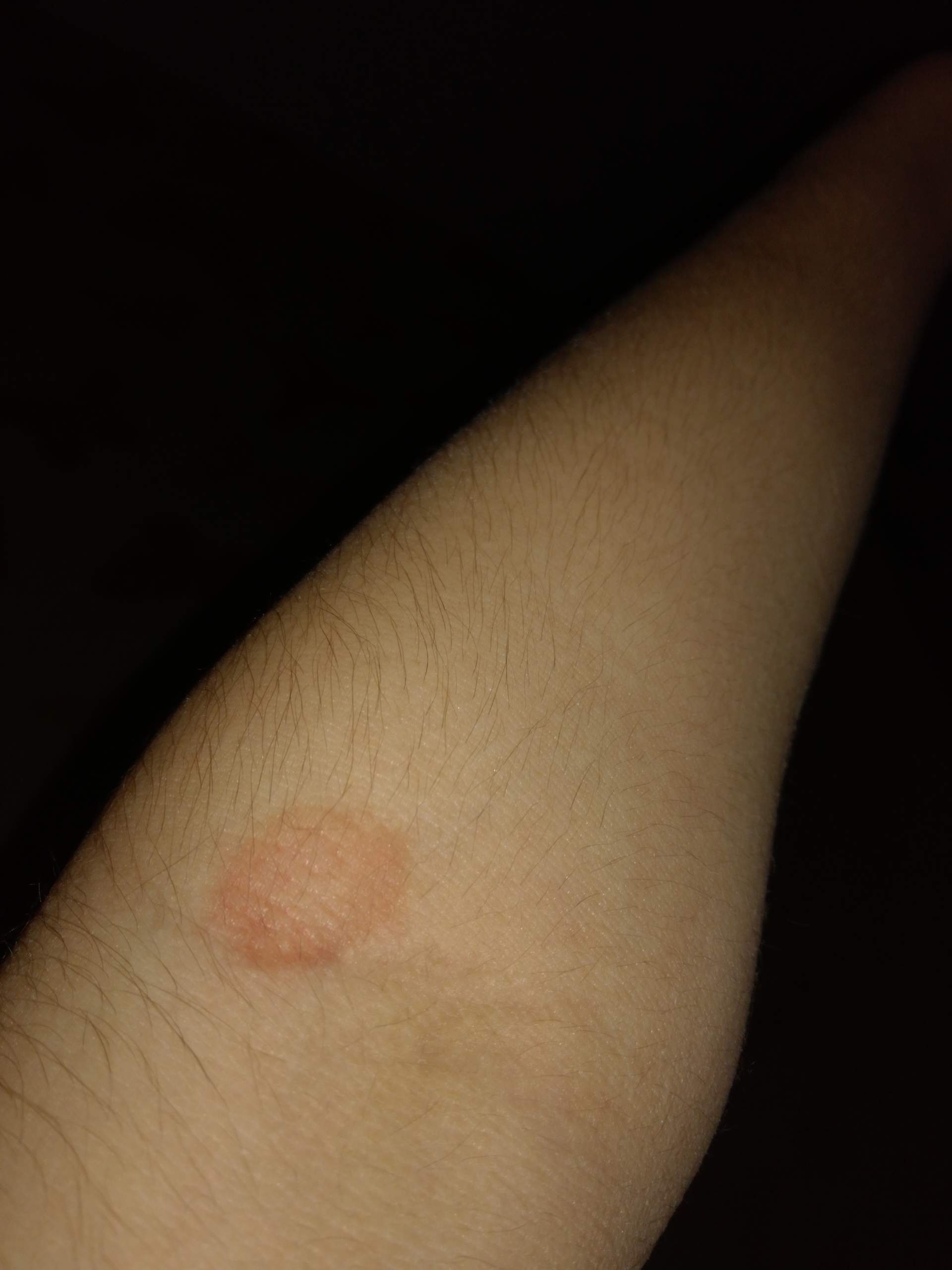 Roter Kreisrunder Fleck Auf Dem Arm Gesundheit Und Medizin Gesundheit Haut Roter Kreisrunder Fleck Auf Dem Arm Gesundheit Und Medizin Gesundheit Haut