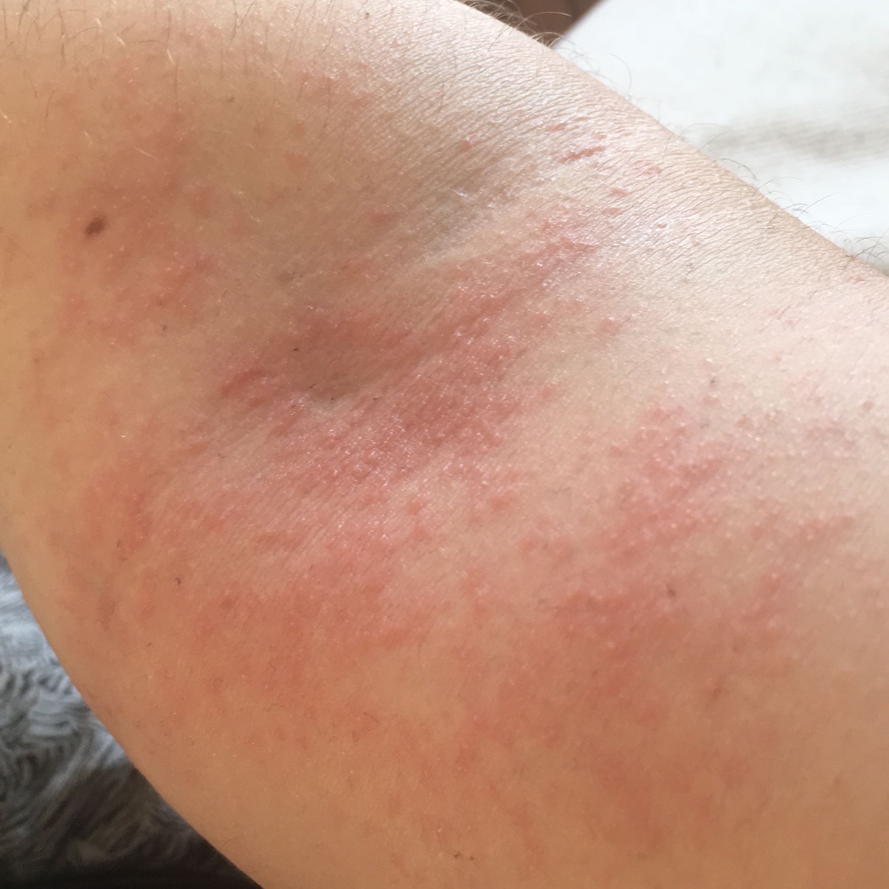 Roter, mit Ganzkleinen Bläschen und etwas juckender Hautasuchlag Hilfe? (Gesundheit und Medizin ...