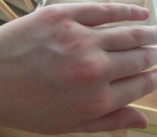 Roter Nicht Juckender Ausschlag Auf Der Hand Krankheit Haut Hautarzt