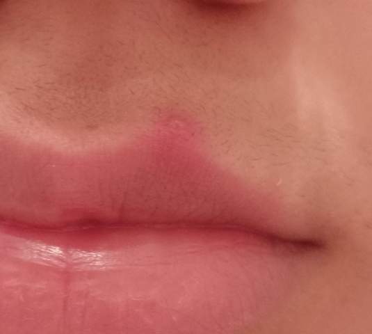 Roter Pickel an der Lippe?
