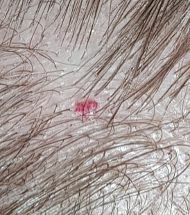 Roter Pickel auf der Kopfhaut. Angst vor Hautkrebs?