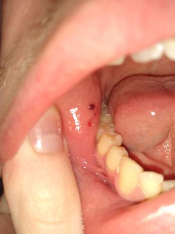 Roter Pickel Im Mund Wangen Innenseite Gesundheit Und Medizin Mundhygiene Roter Pickel Im Mund Wangen Innenseite Gesundheit Und Medizin Mundhygiene