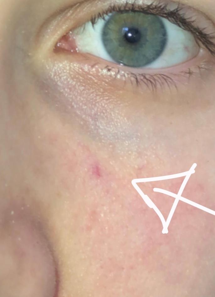 Roter Pickel Unterm Auge Gesundheit Und Medizin Gesundheit Hautprobleme Roter Pickel Unterm Auge Gesundheit Und Medizin Gesundheit Hautprobleme