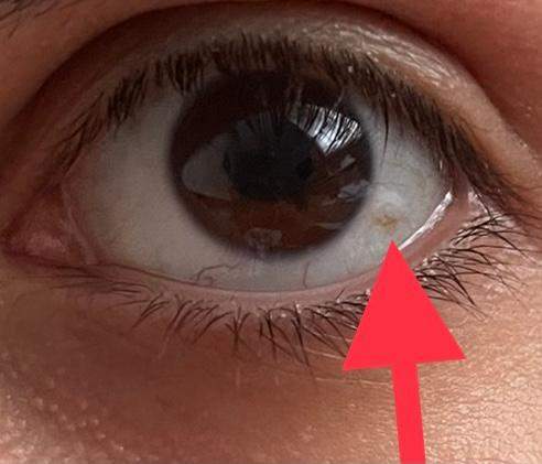 Roter Punkt Am Auge Geht Nicht Weg Gesundheit Und Medizin Gesundheit Medizin Roter Punkt Am Auge Geht Nicht Weg Gesundheit Und Medizin Gesundheit Medizin