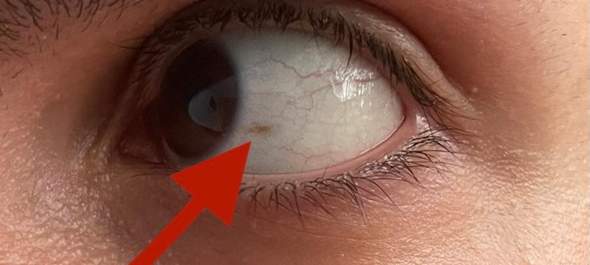 Roter Punkt Am Auge Geht Nicht Weg Gesundheit Und Medizin Gesundheit Medizin Roter Punkt Am Auge Geht Nicht Weg Gesundheit Und Medizin Gesundheit Medizin