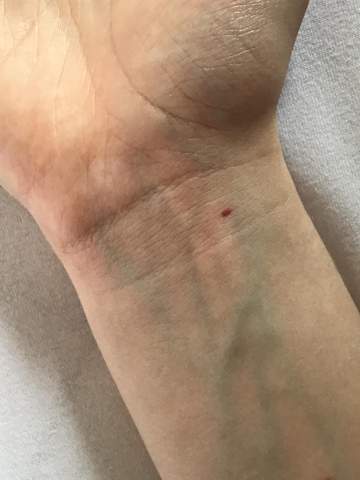 Roter Punkt An Der Hand Gesundheit Und Medizin Haut Seltsam Roter Punkt An Der Hand Gesundheit Und Medizin Haut Seltsam