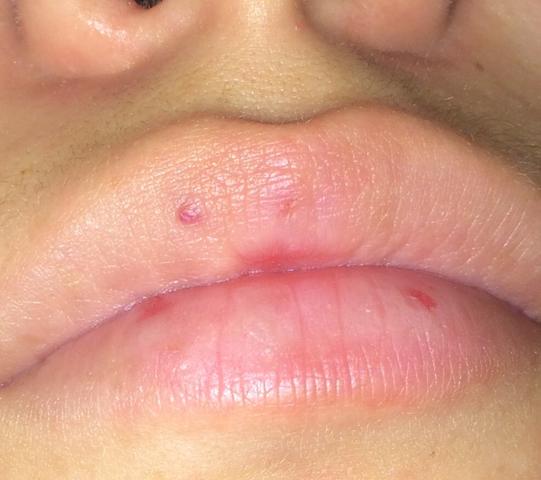 Roter Punkt Auf Der Lippe Kein Herpes Gesicht Roter Punkt Auf Der Lippe Kein Herpes Gesicht