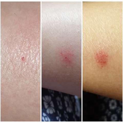 Roter Punkt Breitet Sich Aus Gesundheit Und Medizin Hautarzt Hautprobleme Roter Punkt Breitet Sich Aus Gesundheit Und Medizin Hautarzt Hautprobleme