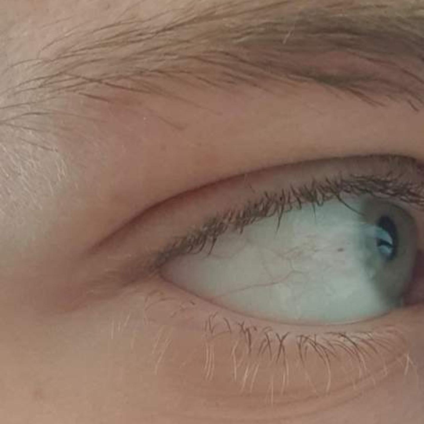 Roter Punkt Im Auge Wandert Gesundheit Und Medizin Gesundheit Medizin Roter Punkt Im Auge Wandert Gesundheit Und Medizin Gesundheit Medizin