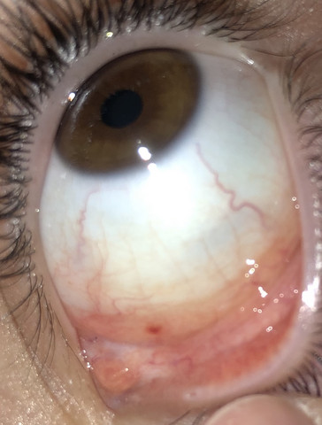 Roter Punkt Neben Dem Tranenwarzchen Auge Gesundheit Augen