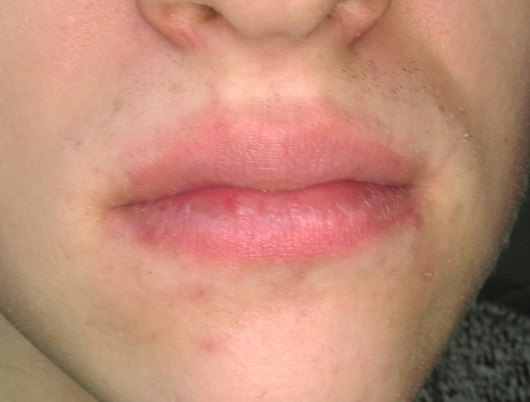 Roter rand um den mund. ? (Gesundheit, Medizin, Lippe)