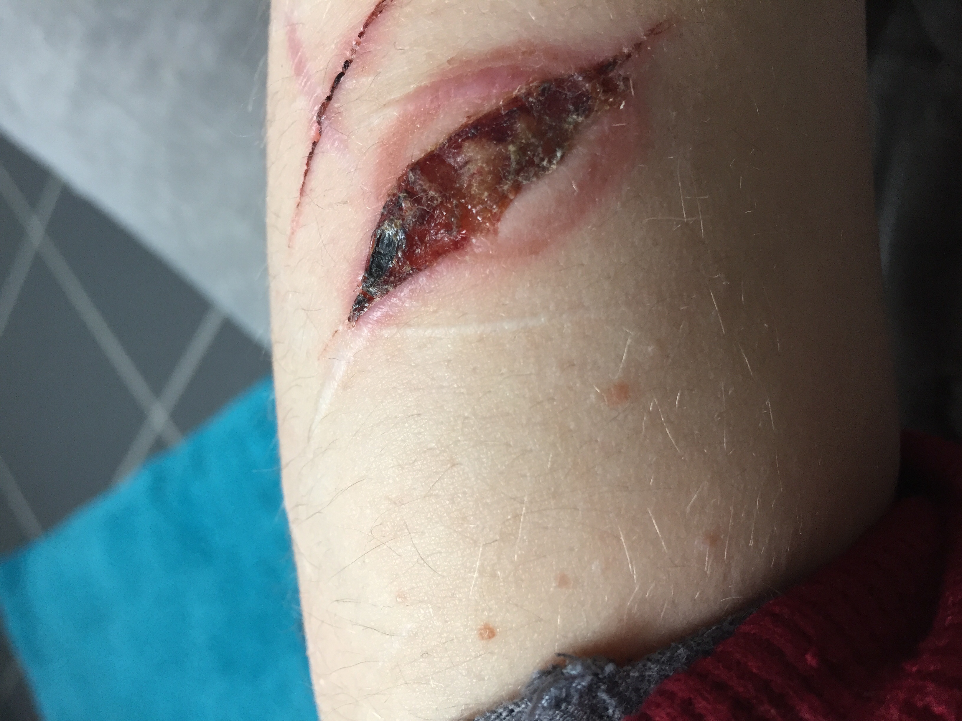 Roter Rand um verletzung (rot, Wunde, Schnittwunde)