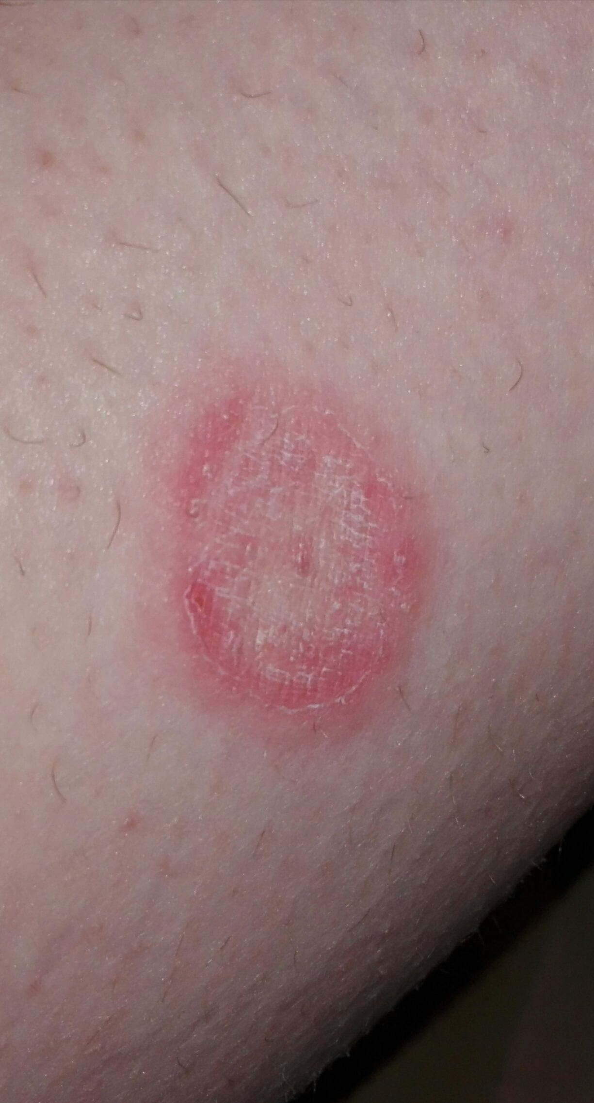 38++ Flecken auf der haut bilder , Roter rauer Fleck auf der Haut. Was ist das? (Gesundheit und Medizin