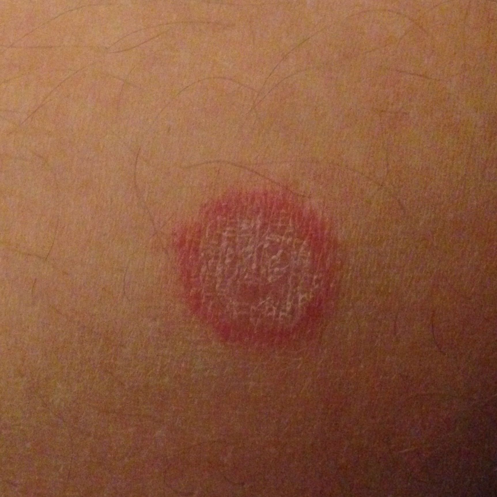 35++ Kreisrunder roter fleck auf der haut bilder , Roter rauer Kreis auf der Haut! (Gesundheit, Medizin, rot)
