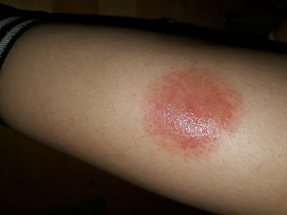 Insektenstich Die Meistgelesenen Fragen Insektenstich Die Meistgelesenen Fragen