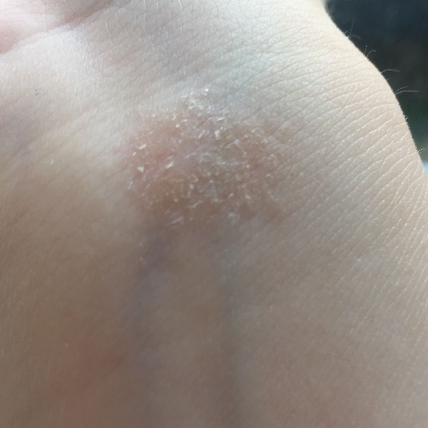 Roter trockener Fleck auf der Haut? (Gesundheit und Medizin, Krankheit