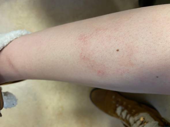 Roter Trockener Wachsender Kreis Auf Der Haut Krankheit Roter Trockener Wachsender Kreis Auf Der Haut Krankheit