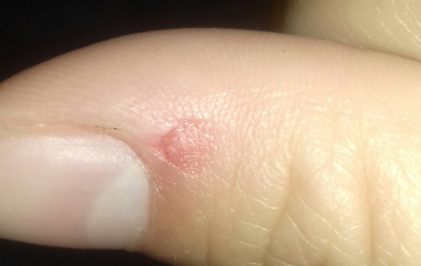 Roter Runderpunkt Am Finger Roter Punkt Roter Runderpunkt Am Finger Roter Punkt