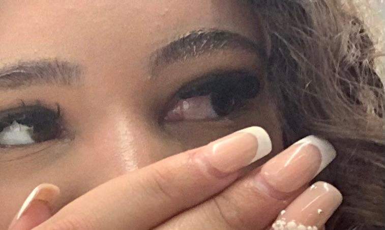 Rotes Auge Einseitig Ohne Schmerzen Erkältung