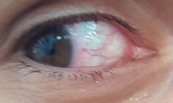 Rotes Auge Mit Strichen Rotes Auge Rotes Auge Mit Strichen Rotes Auge
