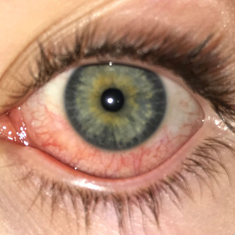 Rotes Auge Nach Bindehautentzundung Krankenhaus Rotes Auge Rotes Auge Nach Bindehautentzundung Krankenhaus Rotes Auge