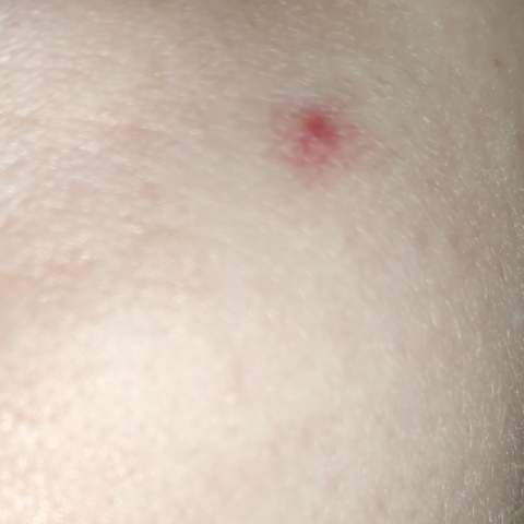 Rotes Muttermal Blutschwammchen Im Gesicht Entfernen Lassen Haut Rotes Muttermal Blutschwammchen Im Gesicht Entfernen Lassen Haut