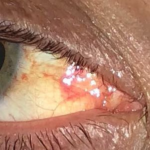 Rot/Gelbliches Auge - (Gesundheit und Medizin, Krankheit, Rote Augen)