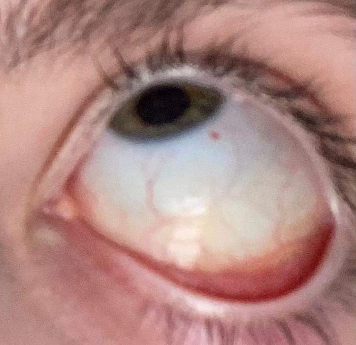 Roze Punkt im Auge? Was tun? Gesundheit, Augen)