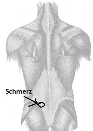 Schmerz - (Sport, Rückenschmerzen, Bandscheibe)