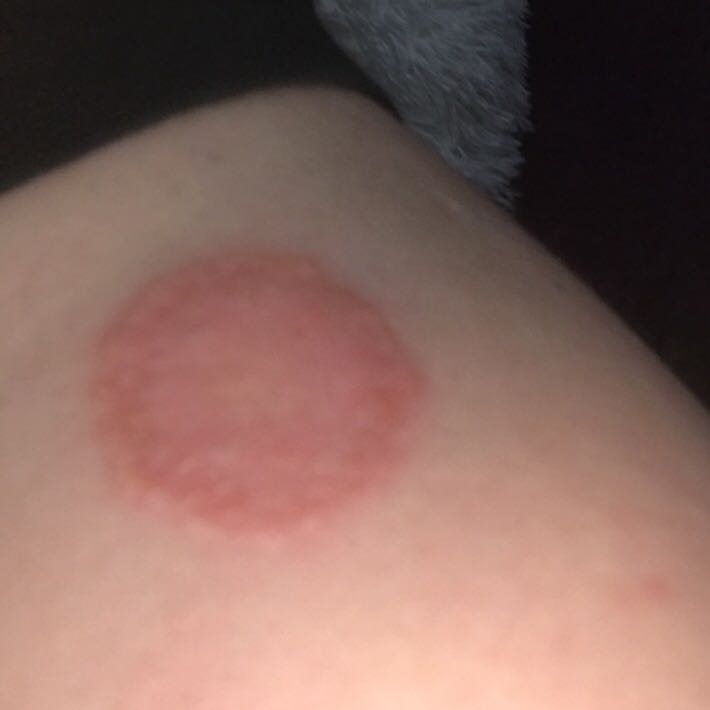 Runder Fleck am Arm? (roterfleck) Runder Fleck am Arm? (roterfleck)