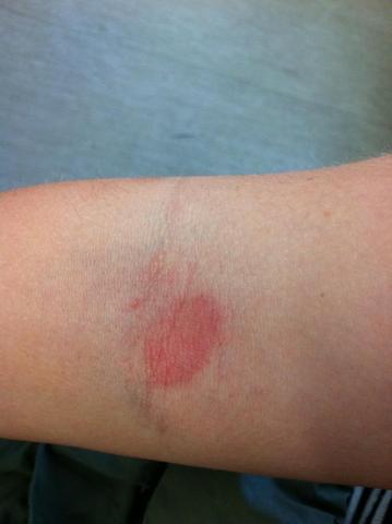 der rote Fleck am Arm - (Krankheit, Flecken, rot)