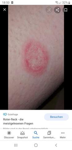 Runter Ausschlag Juckt Etwas Und Ist Dick Haut Roter Fleck Runter Ausschlag Juckt Etwas Und Ist Dick Haut Roter Fleck