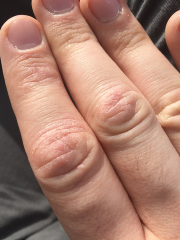 Rissige Haut - (Haut, Hand, Finger)