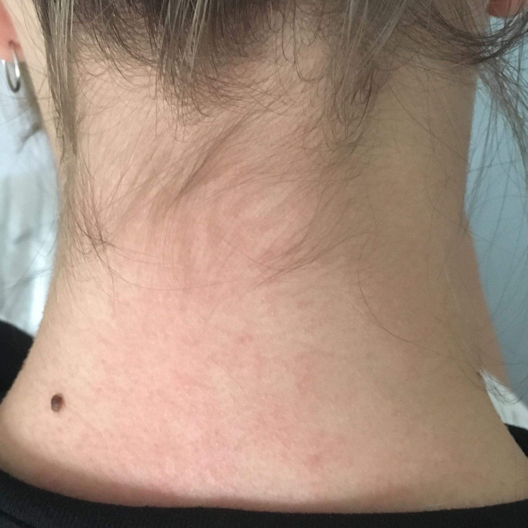 Samtiger Juckender Ausschlag Gesundheit Und Medizin Krankheit Allergie Samtiger Juckender Ausschlag Gesundheit Und Medizin Krankheit Allergie