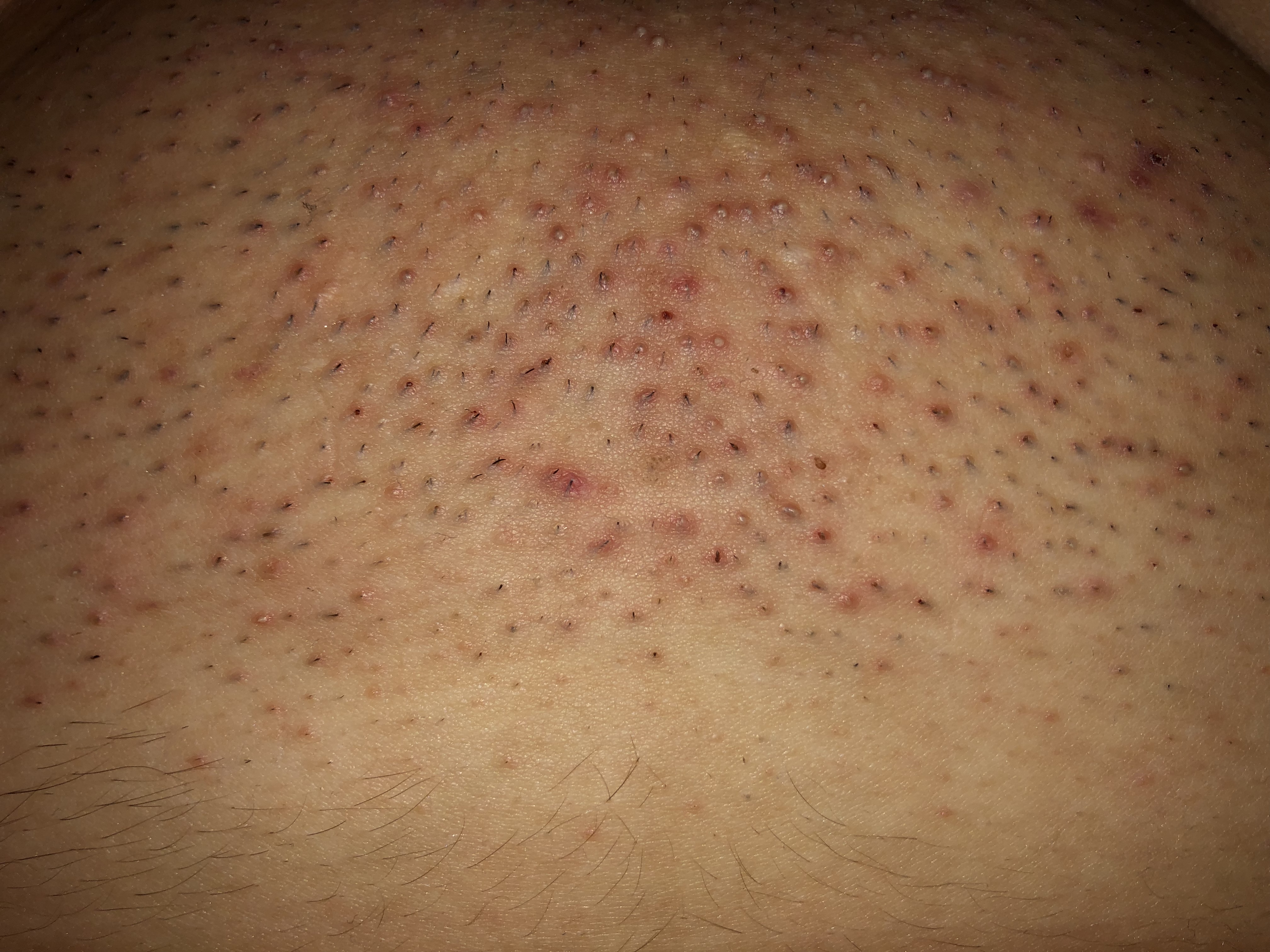 scham haare wachsen extrem ein