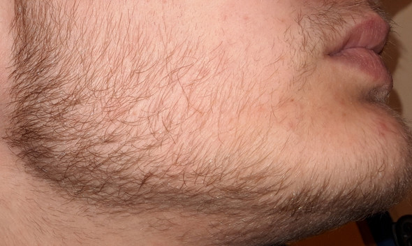 Bartwuchs minoxidil Bartwuchs beschleunigen