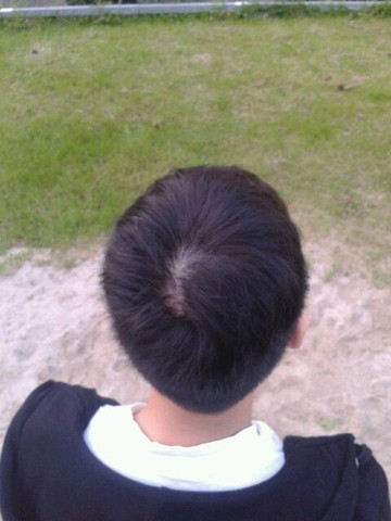 Scheitel Normal Oder Nicht Bekomme Ich Eine Halb Glatze Haare