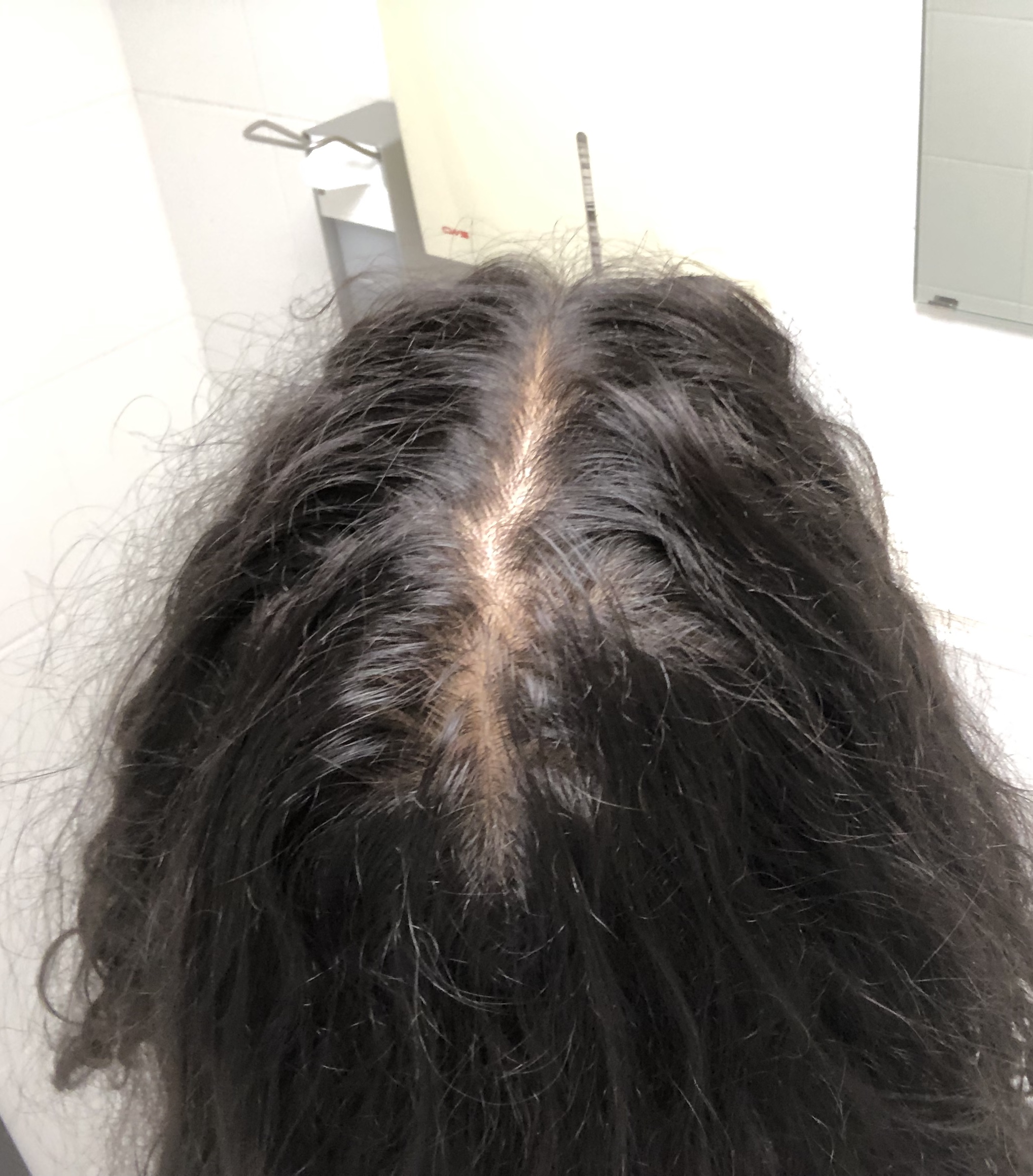 Scheitel Normal Oder Haarausfall Gesundheit Haare Beauty