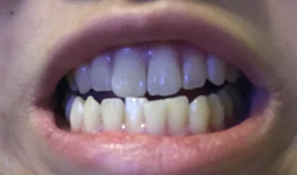 Zähne was tun hässliche Weiße Flecken