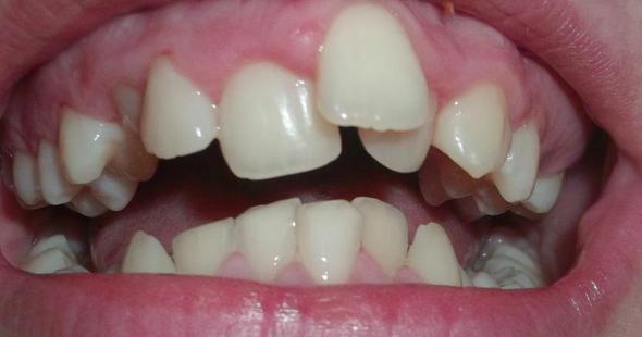 Schiefe Zahne Richten Lassen Behandlung