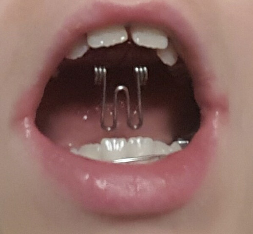 Die "Schlange" im Mund - (Zahnspange, Mund, Kieferorthopädie)