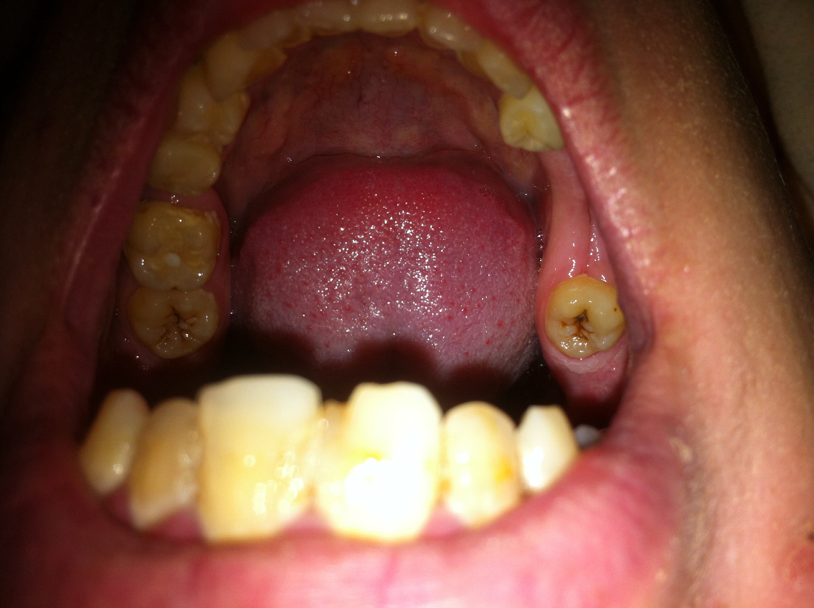 Unechte Zähne