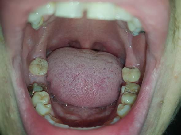 Schlechte Zähne in jungem Alter?