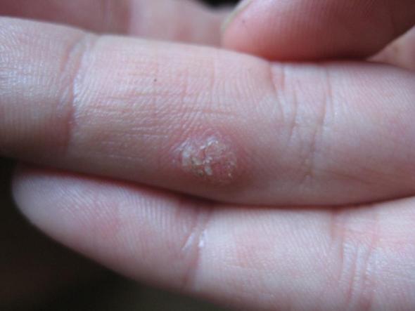 Wird schwarz weh tut warze und Warze