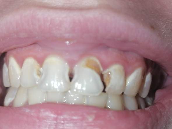 Schlimme zähne, was wäre die Behandlung? (Gesundheit und Medizin)