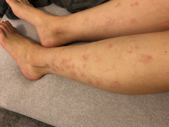 Schlimmer Ausschlag An Beinen Gesundheit Und Medizin Haut Beine Schlimmer Ausschlag An Beinen Gesundheit Und Medizin Haut Beine