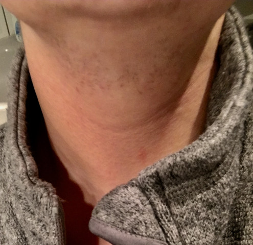 Ihr seht ich habe auch sehr starke Rötung vom rassieren (vor 2 Tagen rasiert)  - (rasieren, Hals, Bart)