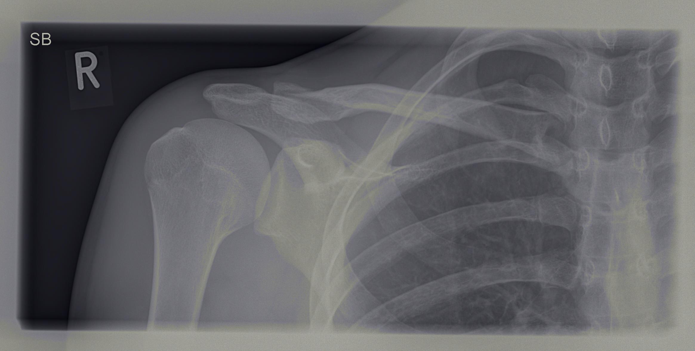 Schlüsselbein angebrochen. Arzt meint es sei wieder verheilt, obwohl ich immernoch Schmerzen Schlüsselbein angebrochen. Arzt meint es sei wieder verheilt, obwohl ich immernoch Schmerzen